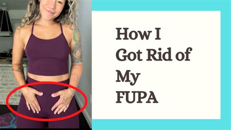 Treating Excess Fat In The Pubic Area (FUPA)